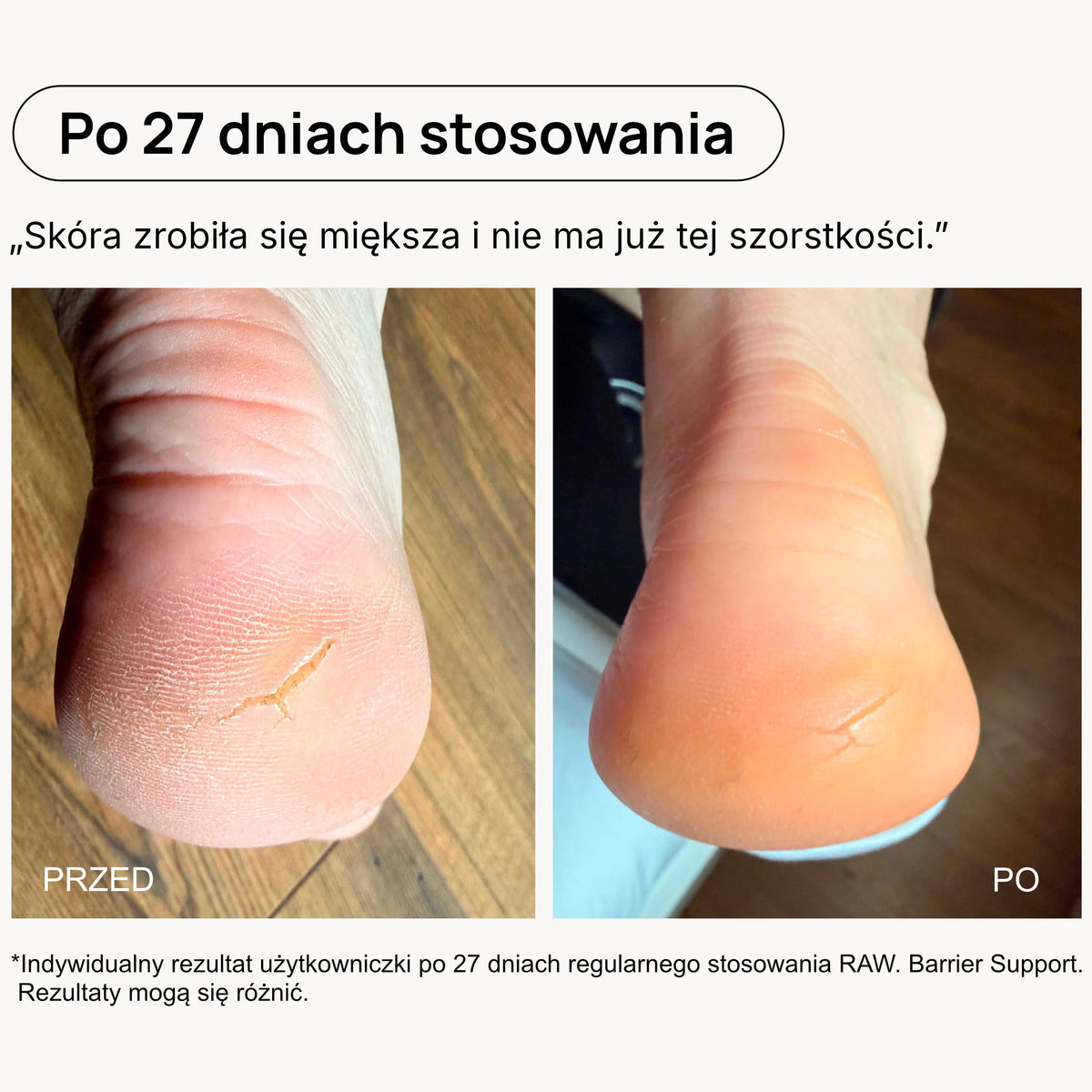 Porównanie wyglądu pięt przed i po 27 dniach stosowania RAW. Barrier Support