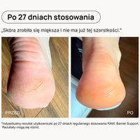 Porównanie wyglądu pięt przed i po 27 dniach stosowania RAW. Barrier Support