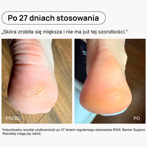 Porównanie wyglądu pięt przed i po 27 dniach stosowania RAW. Barrier Support